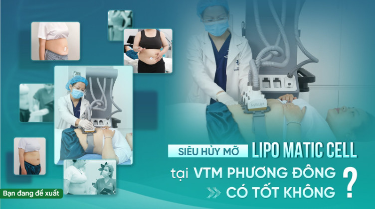 Siêu hủy mỡ Lipo Matic Cell tại Viện thẩm mỹ Phương Đông có tốt không?